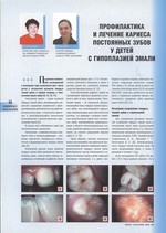 Профилактика и лечение кариеса постоянных зубов у детей с гипоплазией эмали