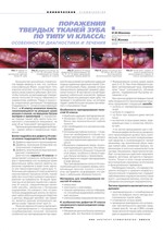 Поражения твердых тканей зуба по типу VI класса: особенности диагностики и лечения