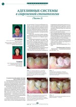 Адгезивные системы в современной стоматологии (Часть 2)