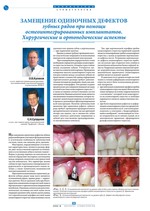 Замещение одиночных дефектов зубных рядов при помощи остеоинтегрированных имплантатов. Хирургические и ортопедические аспекты