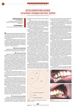 Планирование лечения гиперестезии зубов