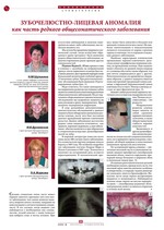 Зубочелюстно-лицевая аномалия как часть редкого общесоматического заболевани