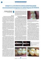 Опыт и алгоритм препарирования окклюзионной поверхности зубов борами SS WHITE