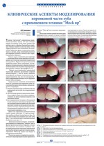 Клинические аспекты моделирования коронковой части зуба с применением техники “Mock up”