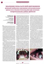Значение показателей цитокинов ротовой жидкости в развитии воспалительных процессов в тканях полости рта при явлениях непереносимости зубных протезов