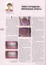 Новое в ортодонтии — лингвальные брекеты