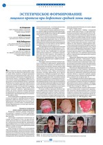 Эстетическое формирование лицевого протеза при дефектах средней зоны лица