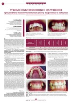 Зубные (окклюзионные) нарушения при синдроме тесного  положения зубов у подростков и взрослых