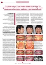 Срединная остеотомия нижней челюсти при сочетанных зубочелюстно-лицевых аномалиях и деформациях: современные возможности, показания и прикладные аспекты