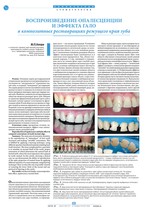 Воспроизведение опалесценции и эффекта гало в композитных реставрациях режущего края зуба