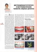 Дистракционный остеогенез в посттравматических челюстно-лицевых дефектах
