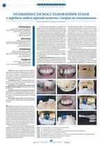Особенности восстановления зубов в переднем отделе верхней челюсти с опорой на имплантаты
