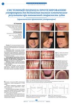Системный подход к протезированию ультранирами для достижения высокого эстетического результата при повышенной стираемости зубов (практическое применение ультраниров)