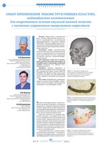 Опыт применения  реконструктивных пластин, индивидуально изготовленных для оперативного лечения опухолей нижней челюсти с частично сохраненным мыщелковым отростком