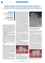 Фиксация сохраненного фрагмента зуба при лечении неосложненных переломов коронок