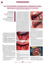Остеотомия срединного нёбного шва (щадящая остеотомия верхней челюсти)