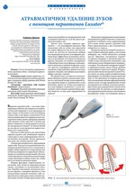 Атравматичное удаление зубов с помощью периотомов Luxator®