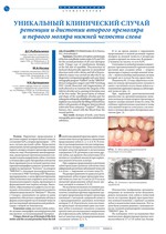 Уникальный клинический случай ретенции и дистопии второго премоляра и первого моляра нижней челюсти слева