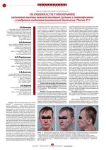 Особенности топографии элементов височно-нижнечелюстного сустава у лептопрозопов с синдромом соединительнотканной дисплазии (Часть IV)