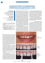 Вариант восстановления эндодонтически пролеченных зубов