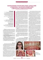 Исправление зубочелюстных аномалий у пациентов с частичной потерей зубов  с применением микроимплантатов