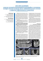Анализ данных конусно-лучевой компьютерной томографии о состоянии моляров нижней челюсти после эндодонтического лечения у первично обратившихся пациентов